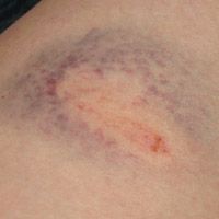 Big bruise, day 2