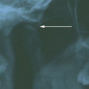 Teeth x-ray detail