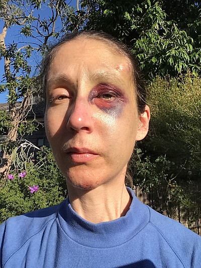 Injuries, 15/5/2020