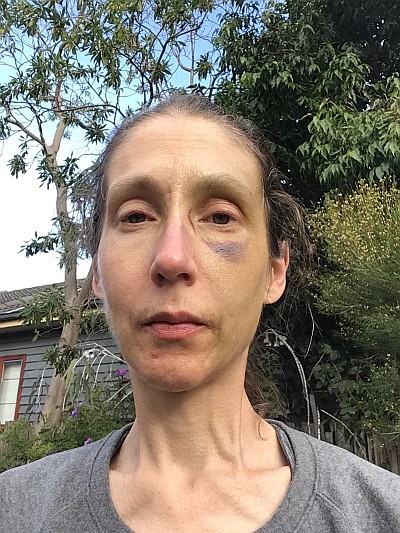 Injuries, 29/5/2020